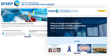 Le avant / après de la Société Française de la Sclérose en Plaques (SFSEP)